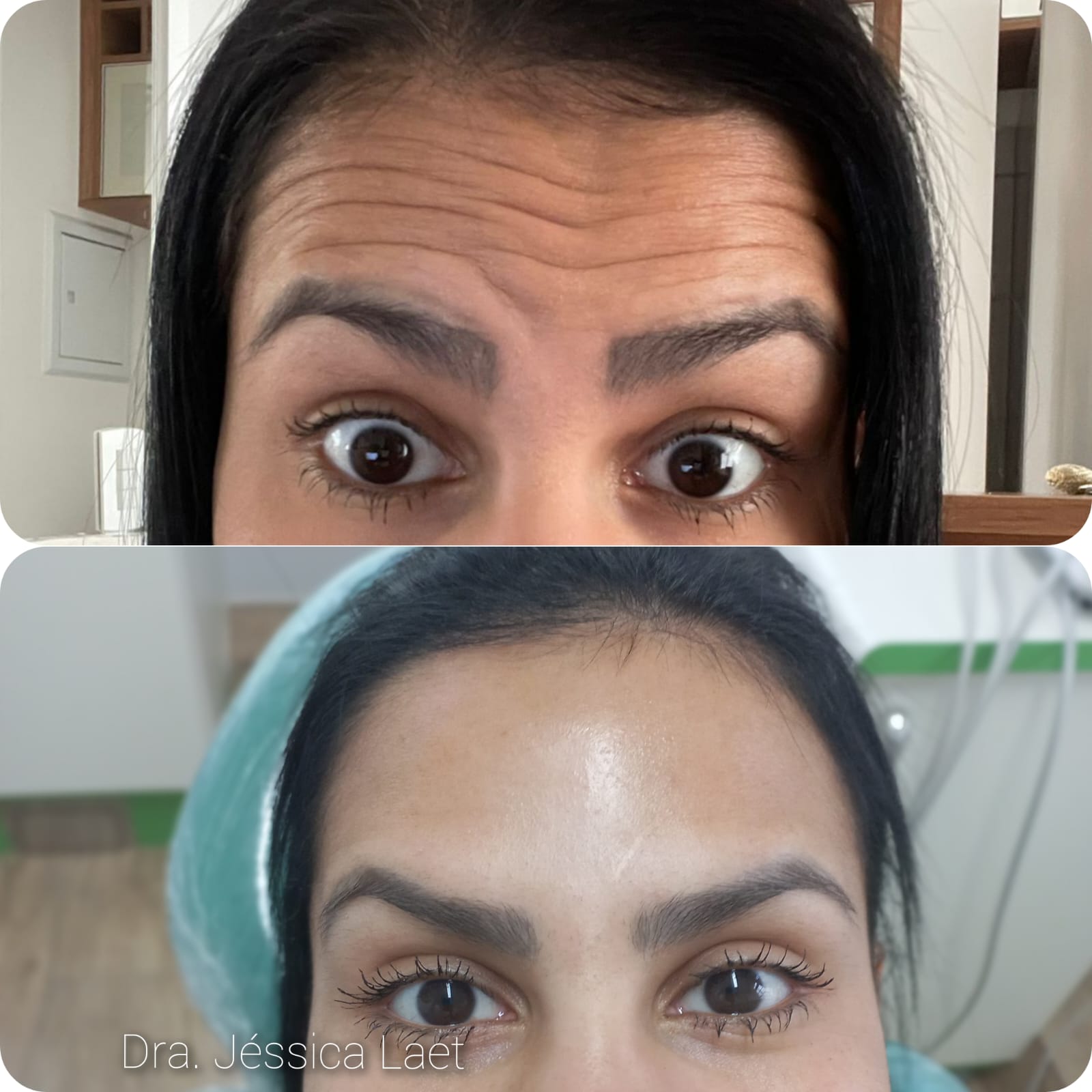 Antes e depois de aplicação de botox na testa