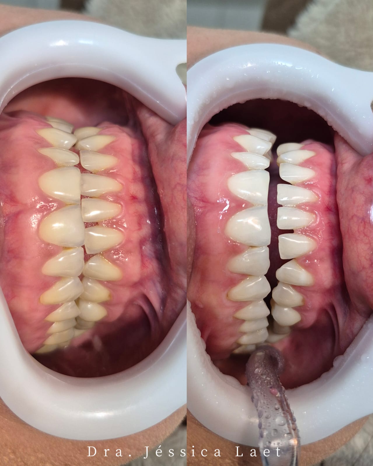 Antes e depois de clareamento dental em Ferraz de Vasconcelos