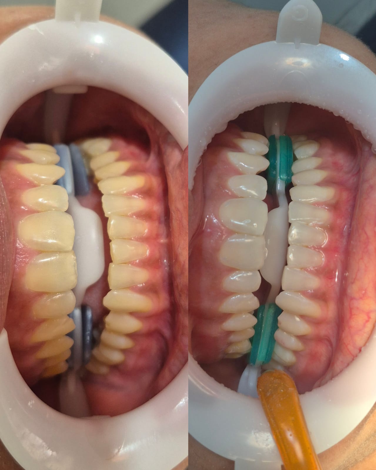 Antes e depois de restauração dentária