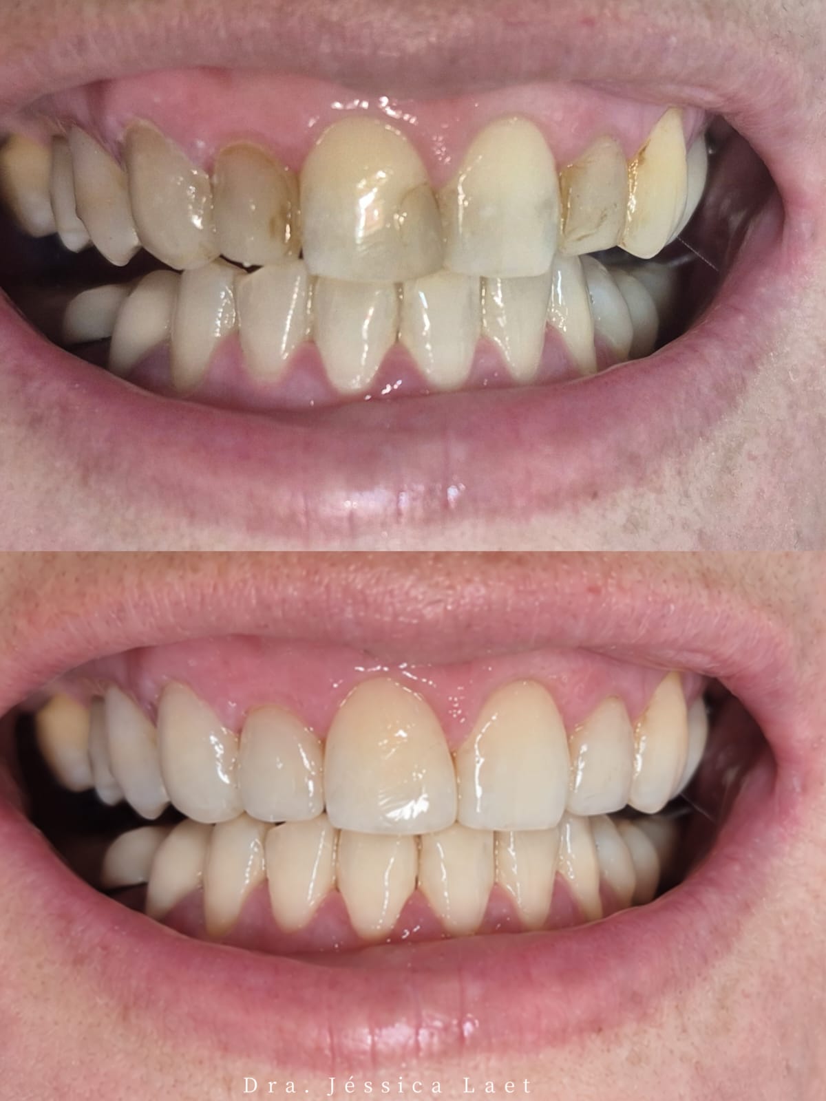 Antes e depois de sorriso tratado na Laet Odontologia