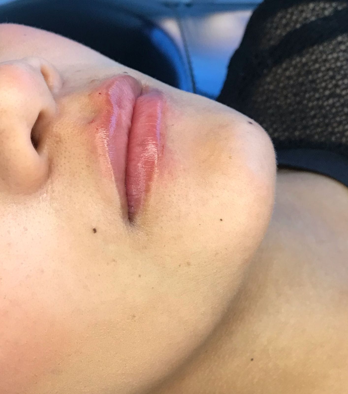 Preenchimento labial na Laet Odontologia